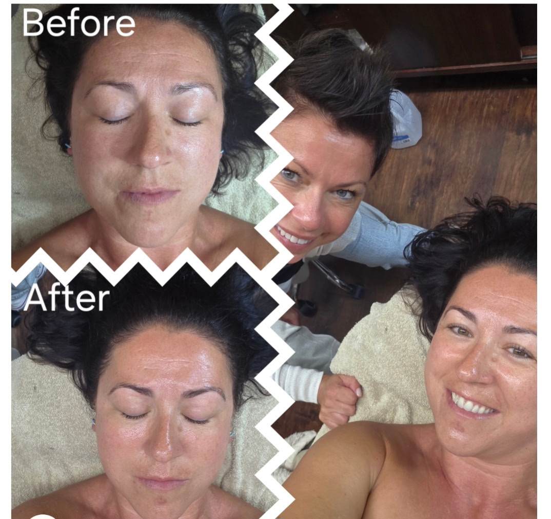 Why Everyone Loves the Hydrafacial Glow