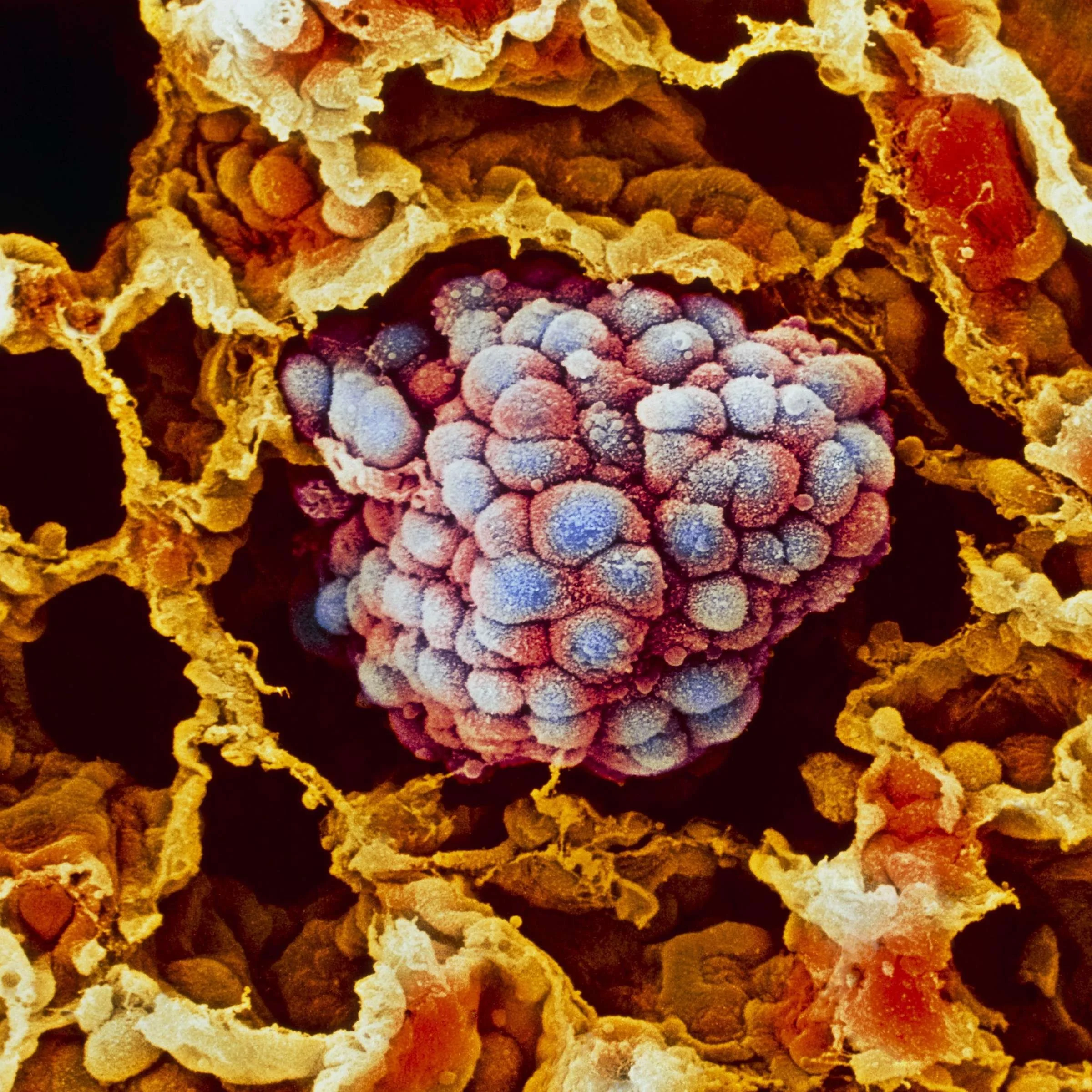 Artemisia annua in der Onkologie