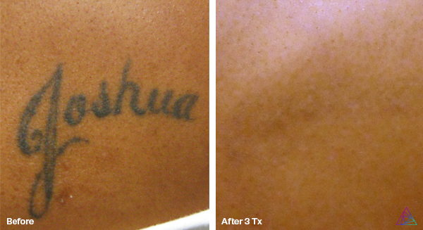 Imperio Ink Laser Tattoo Removal Before and After