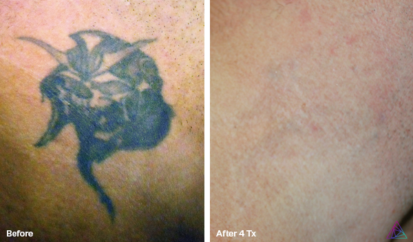 Imperio Ink Laser Tattoo Removal Before and After