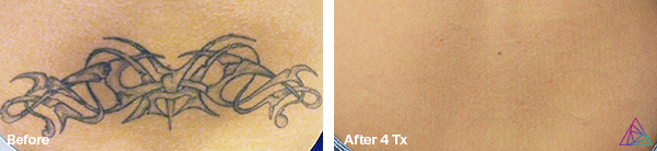 Imperio Ink Laser Tattoo Removal Before and After