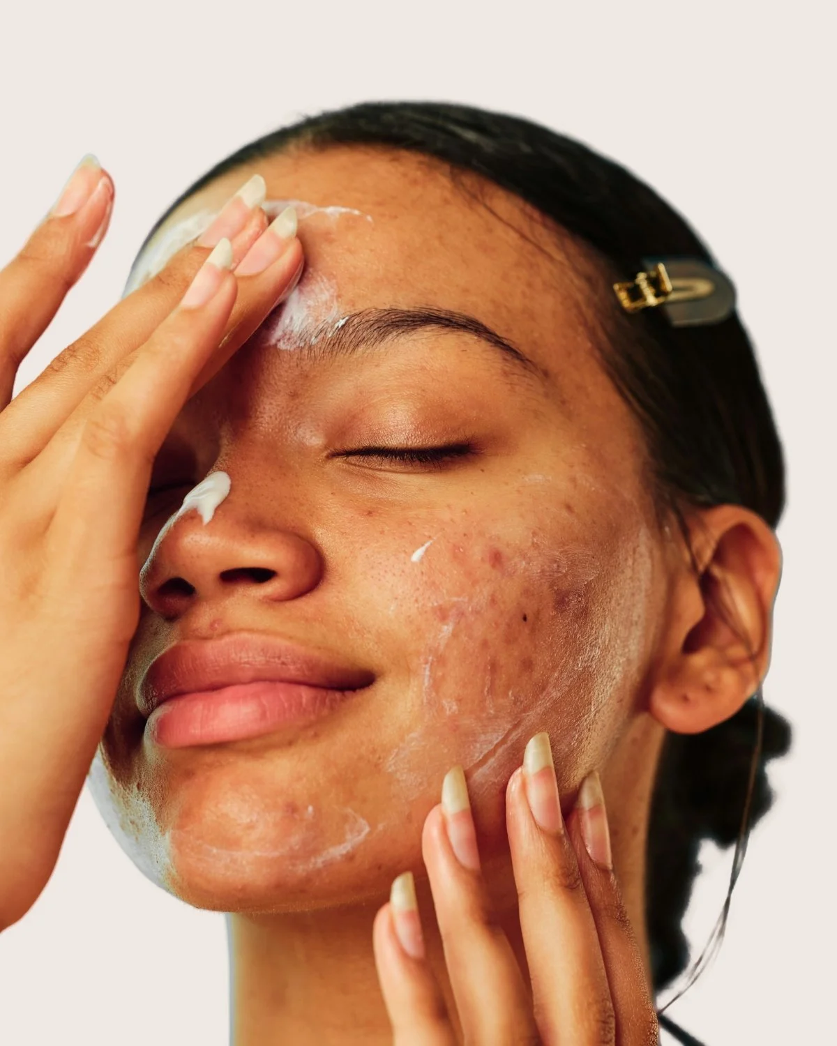 What's Your Acne Pattern quiz by Elevada Wellness