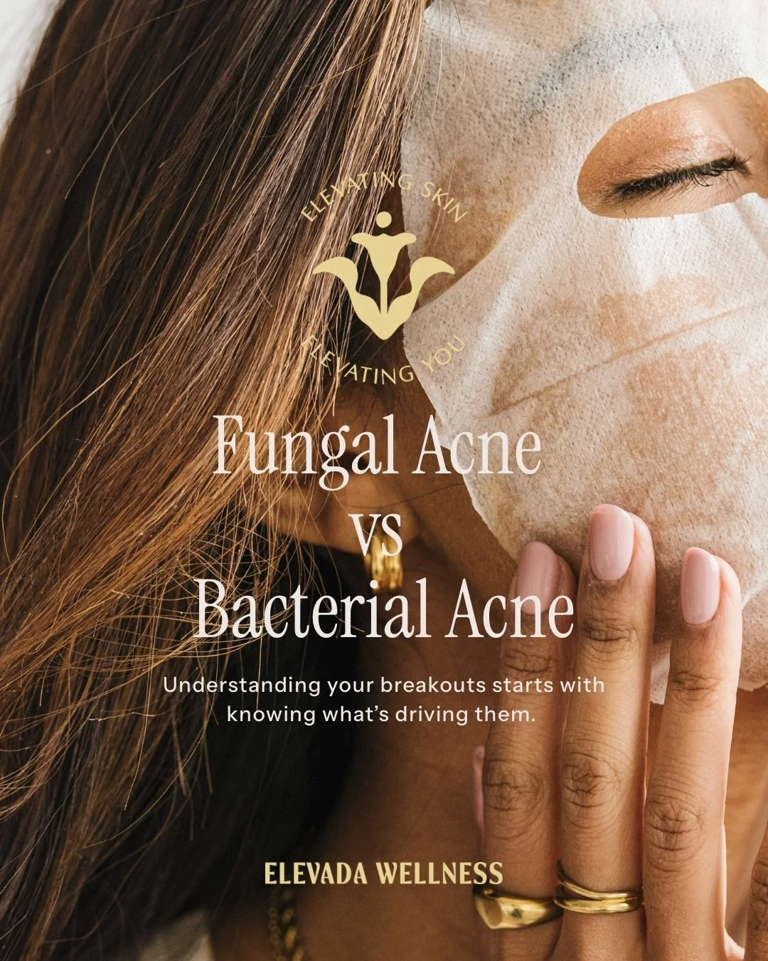 Many people assume every breakout is the same - but fungal acne and bacterial acne have different underlying causes and often require different treatment approaches.

Understanding why you&rsquo;re breaking out is just as important as knowing what yo