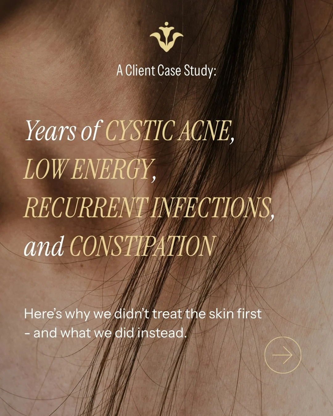This is why I don&rsquo;t believe in treating symptoms in isolation.

This client came to me after years of struggling with acne. Rather than focusing solely on their skin, we took a step back and looked at the bigger picture.

Through comprehensive 