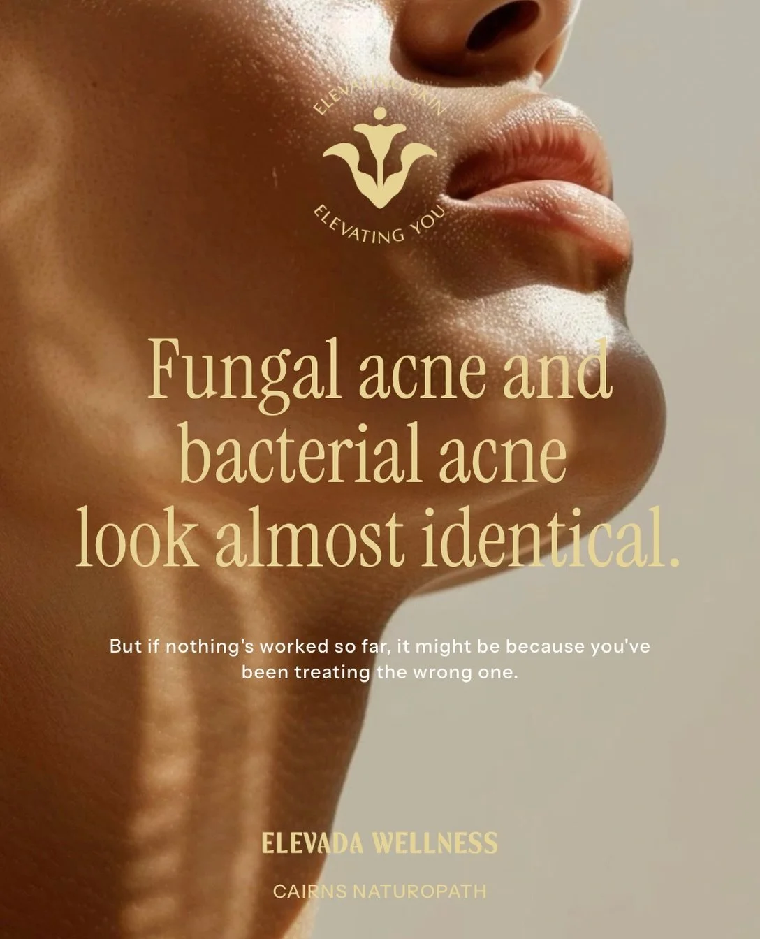 Fungal acne and bacterial acne can look almost identical, and most standard acne treatment won&rsquo;t even touch the fungal kind.

Have you been treating acne for months with nothing to show for it? This may be the reason why.