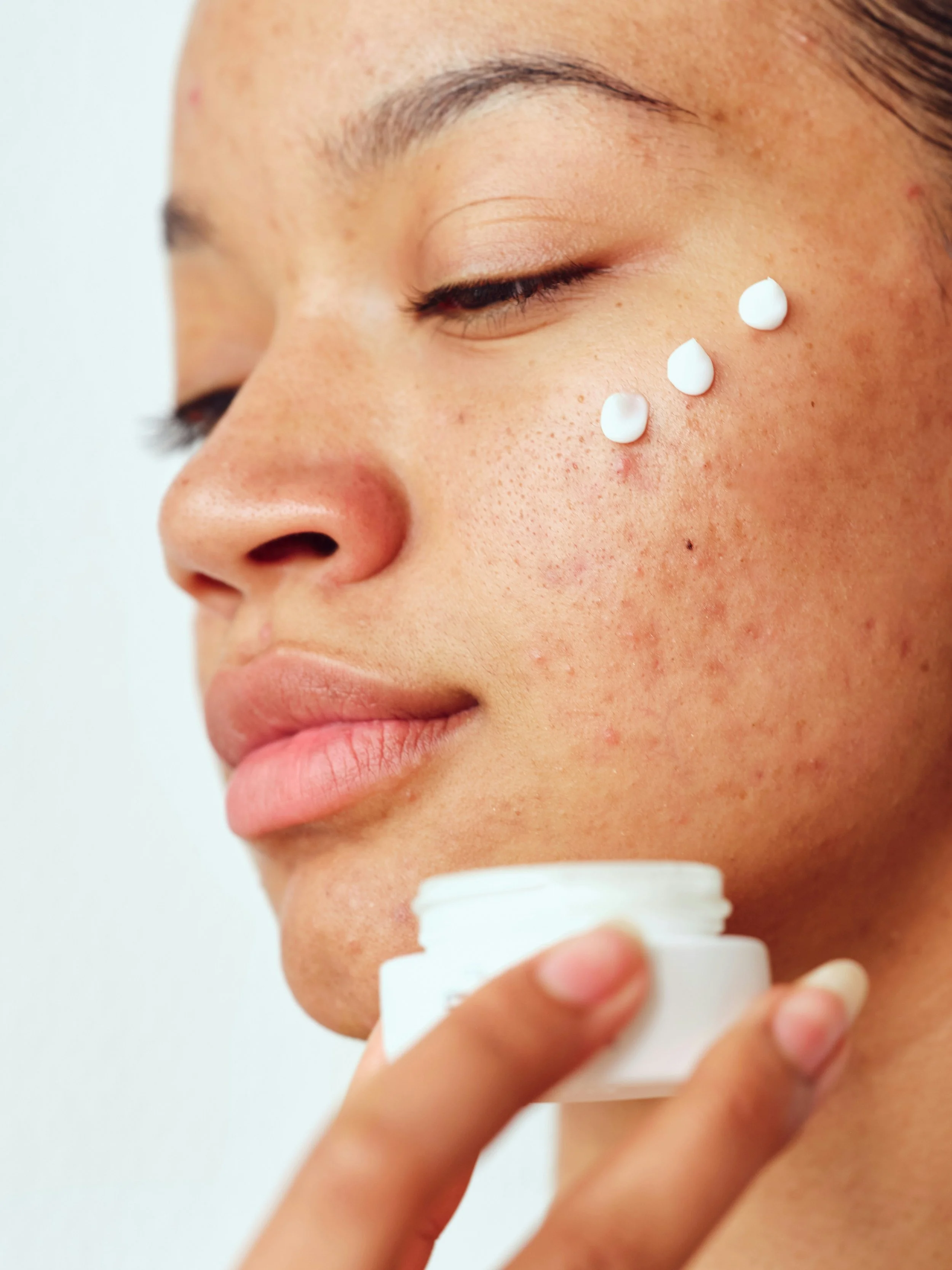 What's Your Acne Pattern quiz by Elevada Wellness