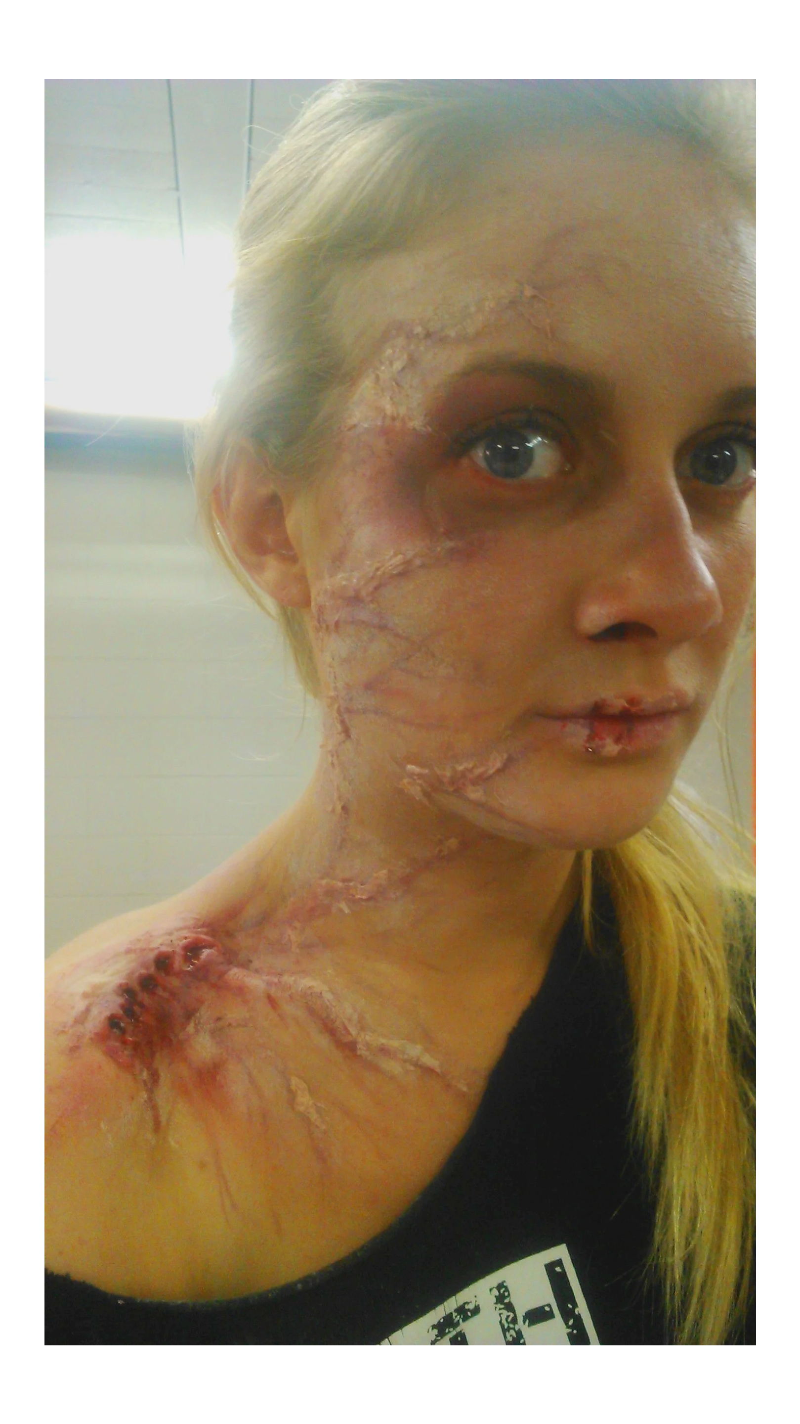 A woman with burn scars on her face, neck, and shoulder, looking at the camera with a neutral expression.