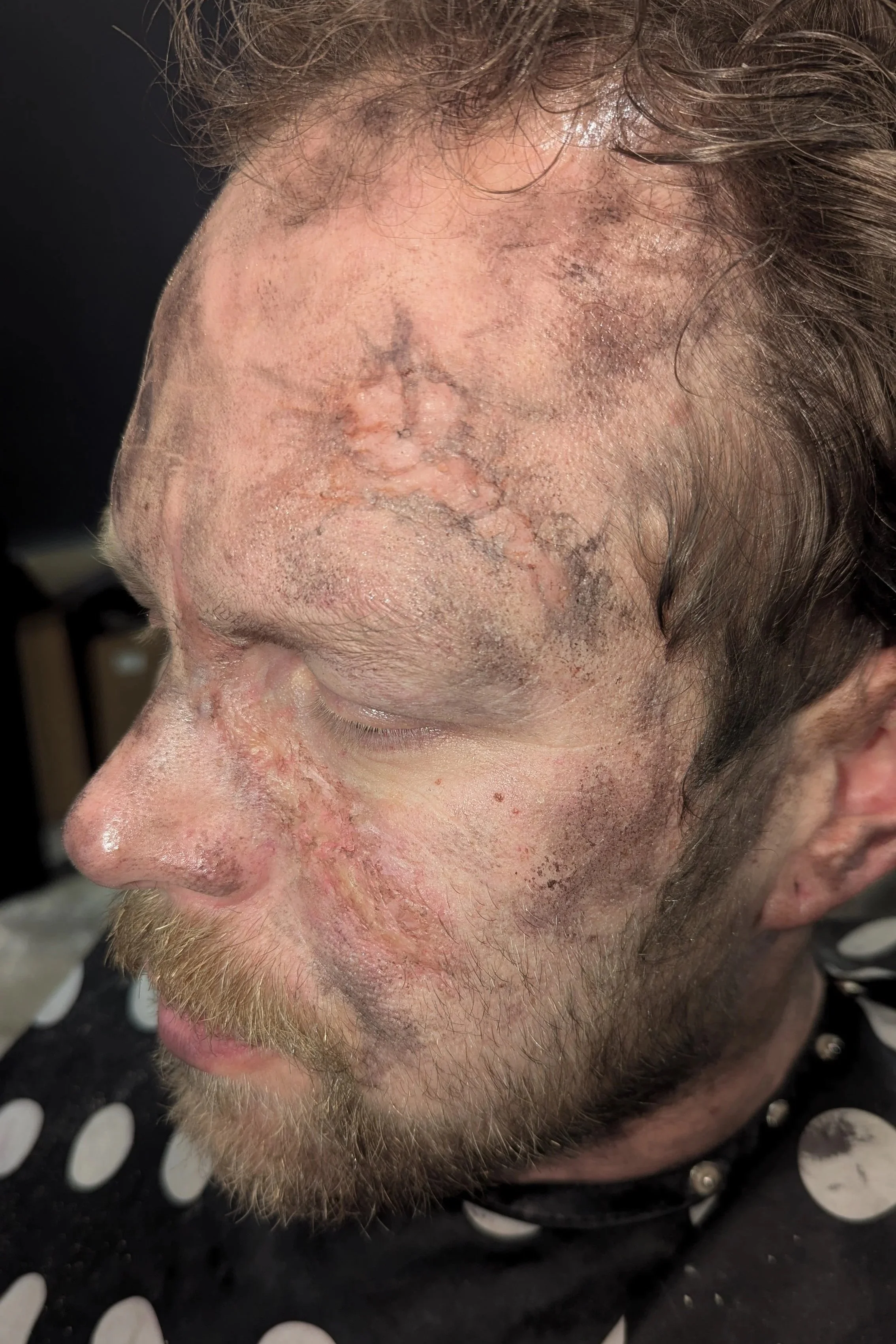 Close-up of a man’s face with severe facial trauma, including extensive scarring, swelling, and visible blood vessels.