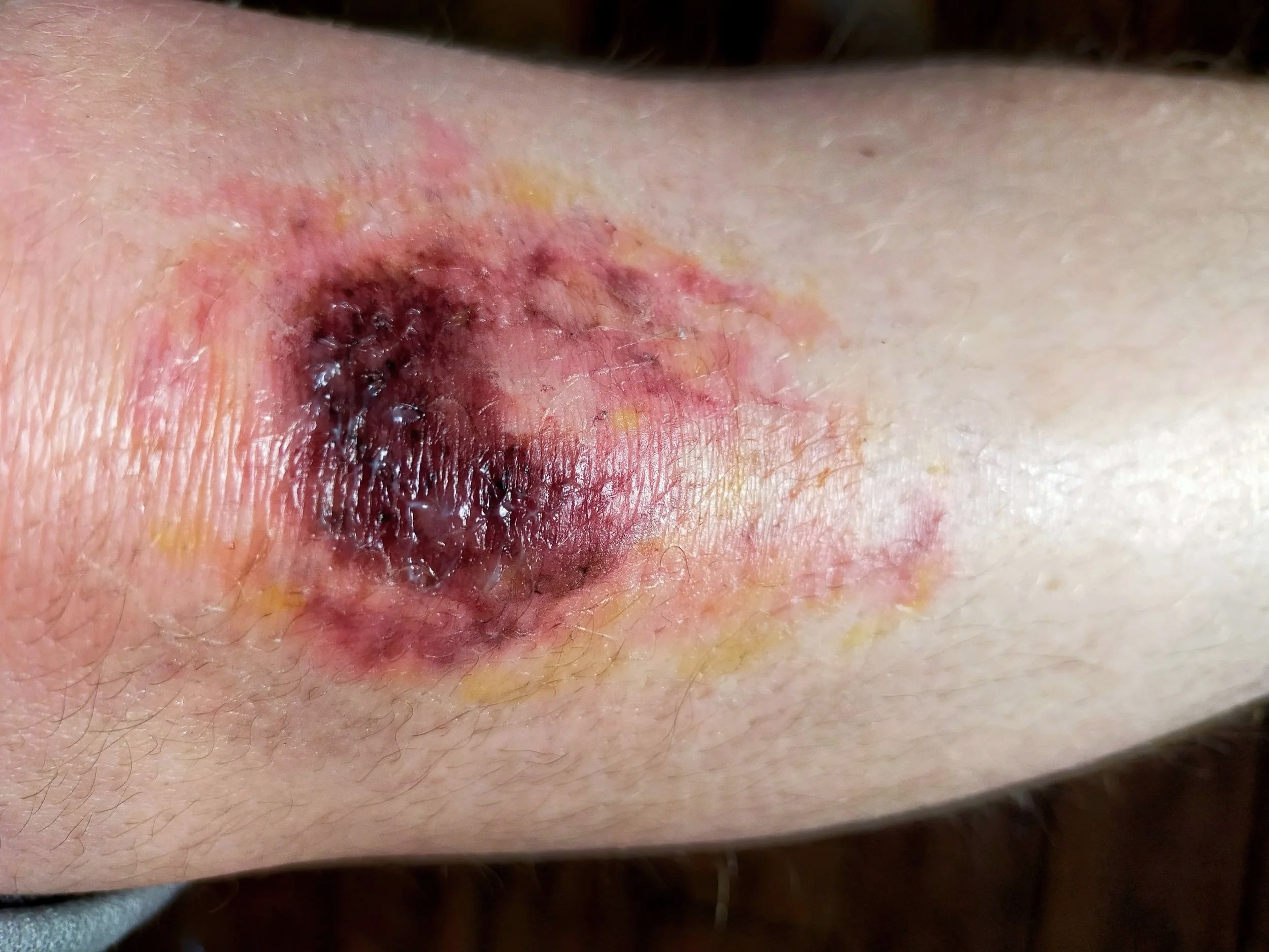 Close-up of a skin wound that is red, swollen, with black and yellow tissue, indicating a possible infection or necrosis.