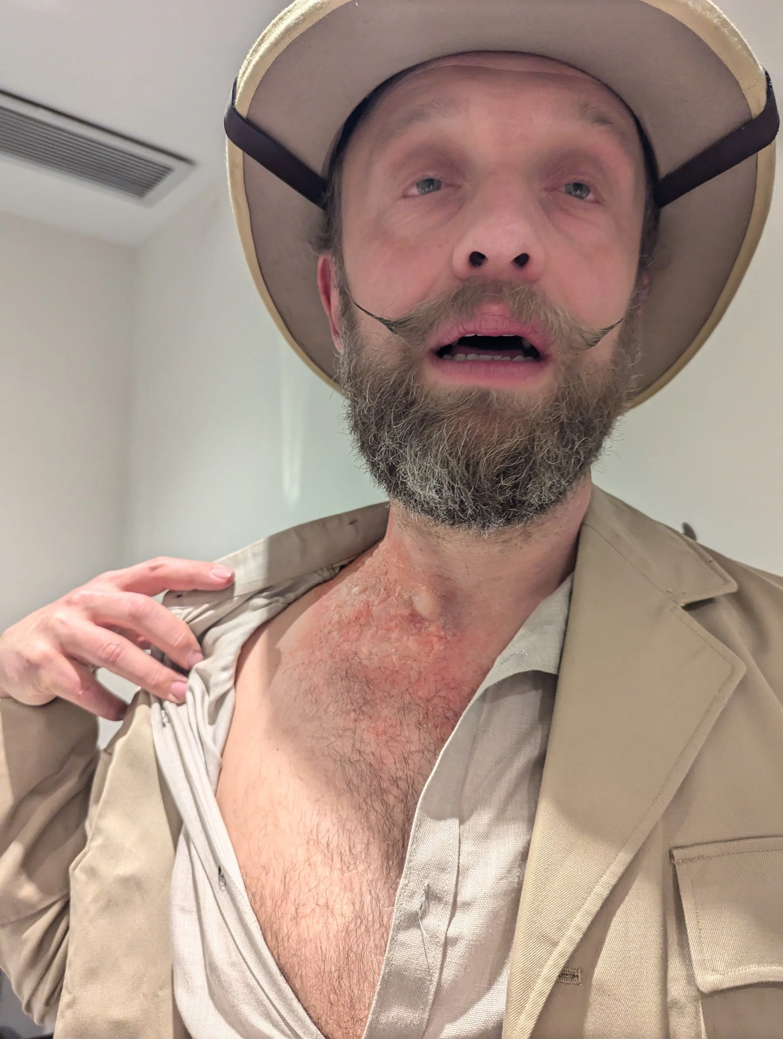 A person with a beard, mustache, and light blue eyes wearing a safari hat and a beige jacket, pulling down their shirt to reveal a red, sunburned chest.