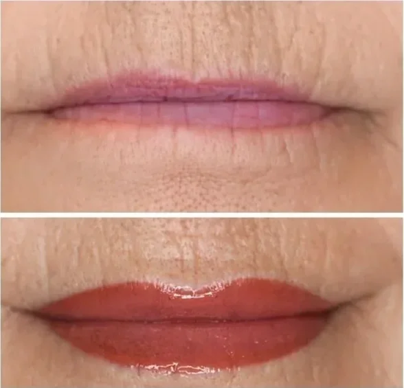 Comparison of lips before and after applying lip contouring treatment.