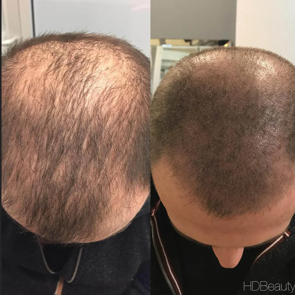 Before and after images of a man's scalp showing hair scalp micropigmentation treatment, with the left side showing thinning hair and the right side showing a fuller, more even hair pattern.