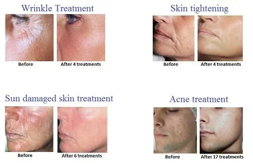 Comparison images showing skin improvements after various treatments: wrinkles, skin tightening, sun-damaged skin, and acne, with before and after photos.