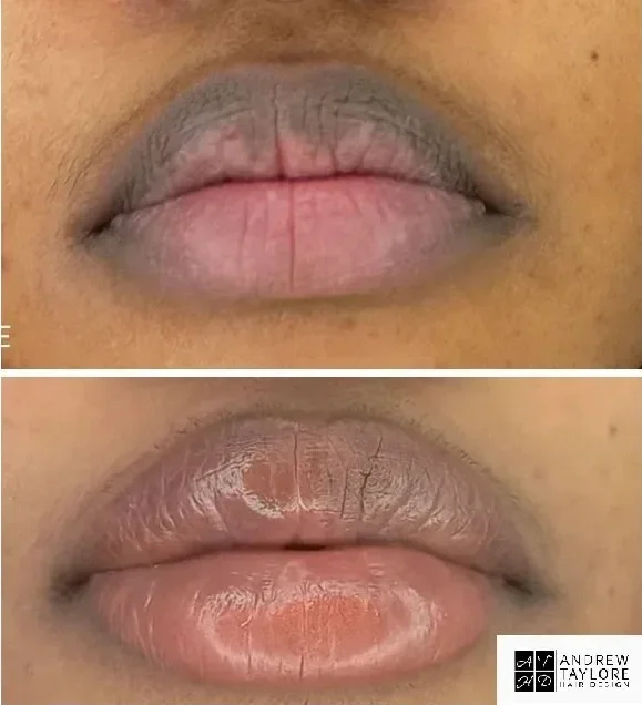 Close-up of lips, showing before and after cosmetic lip treatment, with visible change in lip color and balance.