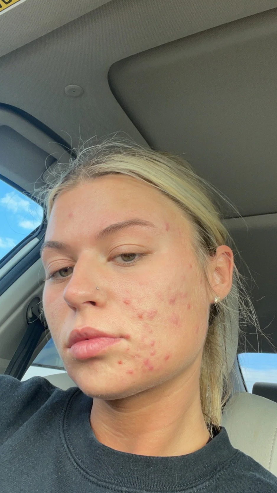 Close-up of a young woman with blonde hair, acne, and a nose piercing sitting in a car with a window showing a blue sky outside.