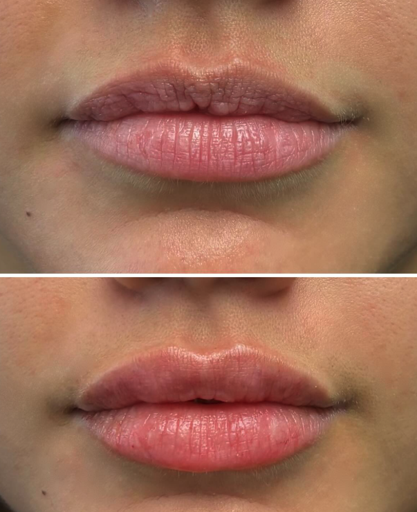 What is Restylane Kysse?