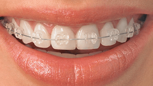Close-up of a person's smile showing teeth with clear braces