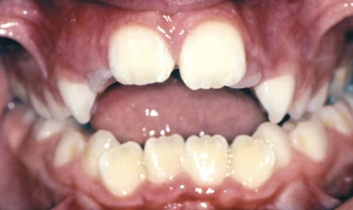 Close-up of a person's mouth showing missing upper front teeth and misaligned lower teeth.