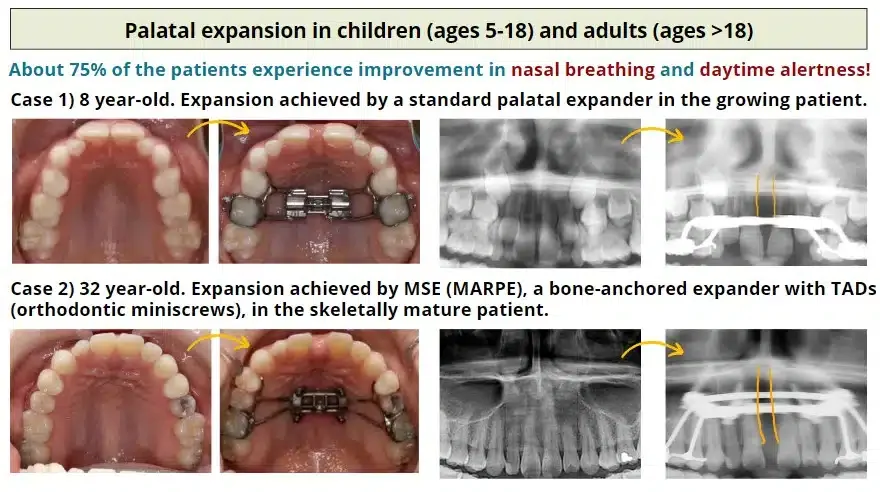 Diagram showing palatal expansion in children and adults with photos and X-rays. The top row shows an 8-year-old's palate before and after expansion with a palatal expander. The bottom row shows a 32-year-old's palate before and after expansion with a bone-anchored expander and TADs. Text explains about 75% of patients experience improvement in nasal breathing and daytime alertness.