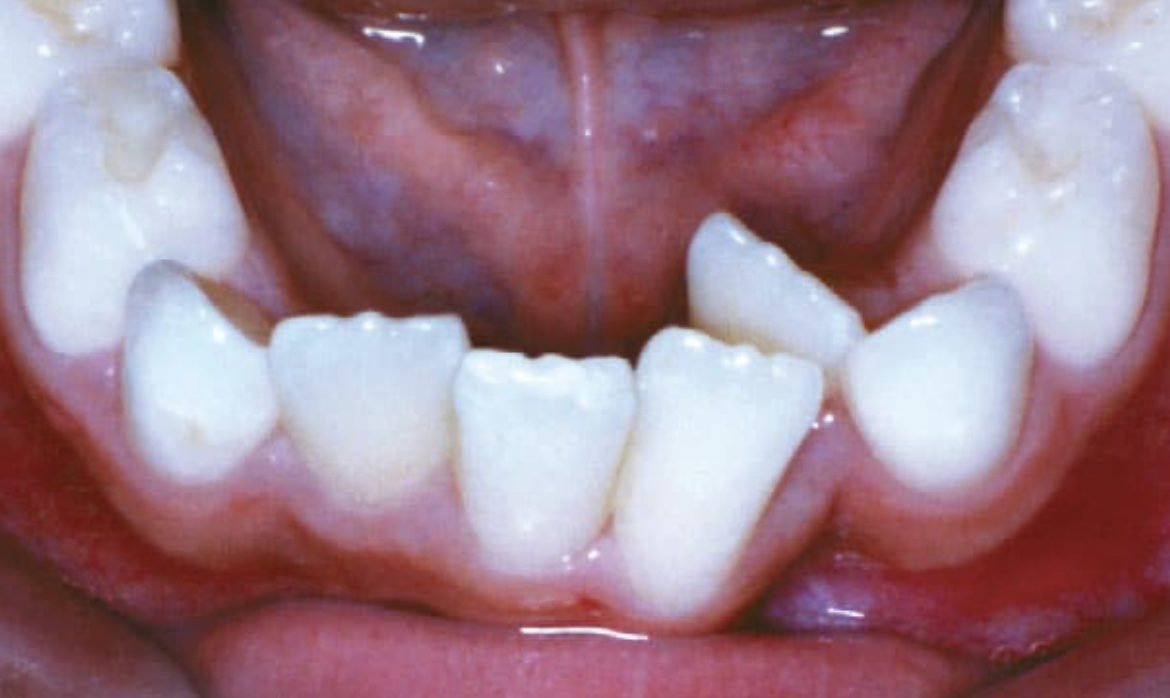Close-up of a child's upper and lower front teeth with gaps and misalignment.