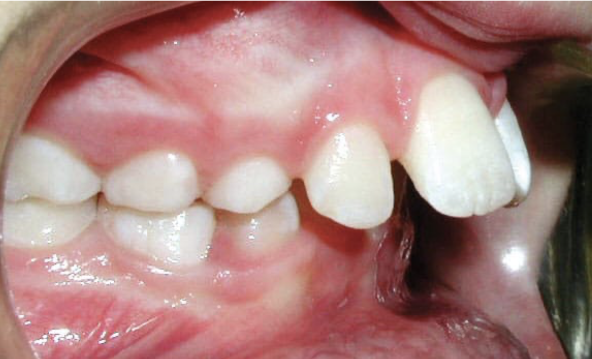 Child's mouth with crooked, spaced, and misaligned upper teeth.