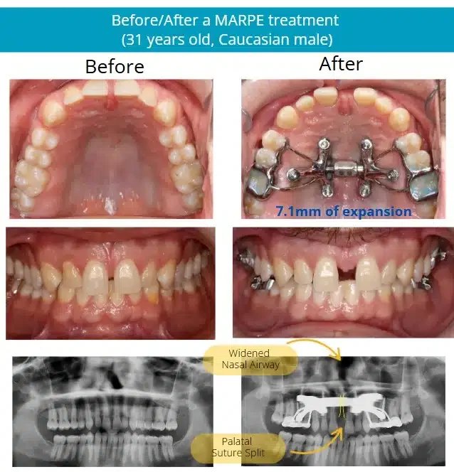 Comparison of a 31-year-old Caucasian male's teeth before and after MARPE treatment. The 'before' shows crowded teeth and narrow nasal airway; the 'after' shows expanded upper jaw with a device attached and widened nasal passage. X-ray images indicate palatal suture split and increased nasal airway.
