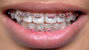 A close-up of a person's smile showing braces on their teeth.