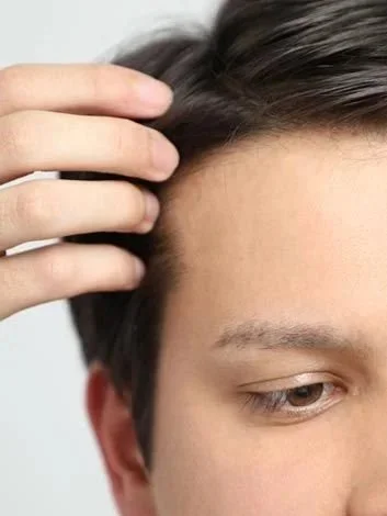 Man examining his hairline and scalp after a hair transplant in Ottawa
