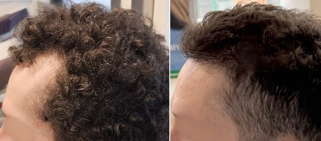 FUE Hair Transplant Before and After – Temporal Hairline