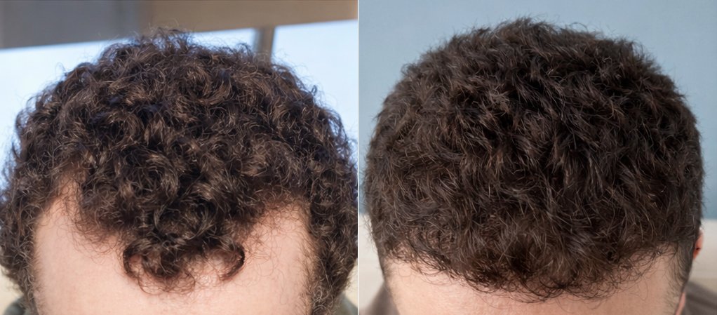 FUE Hair Transplant Before and After – Temporal Hairline