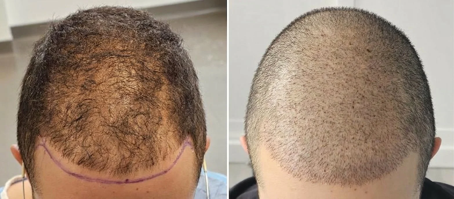 FUE Hair Transplant Before and After – Crown Density and Hairline Restoration | Apex Hair Restoration Ottawa