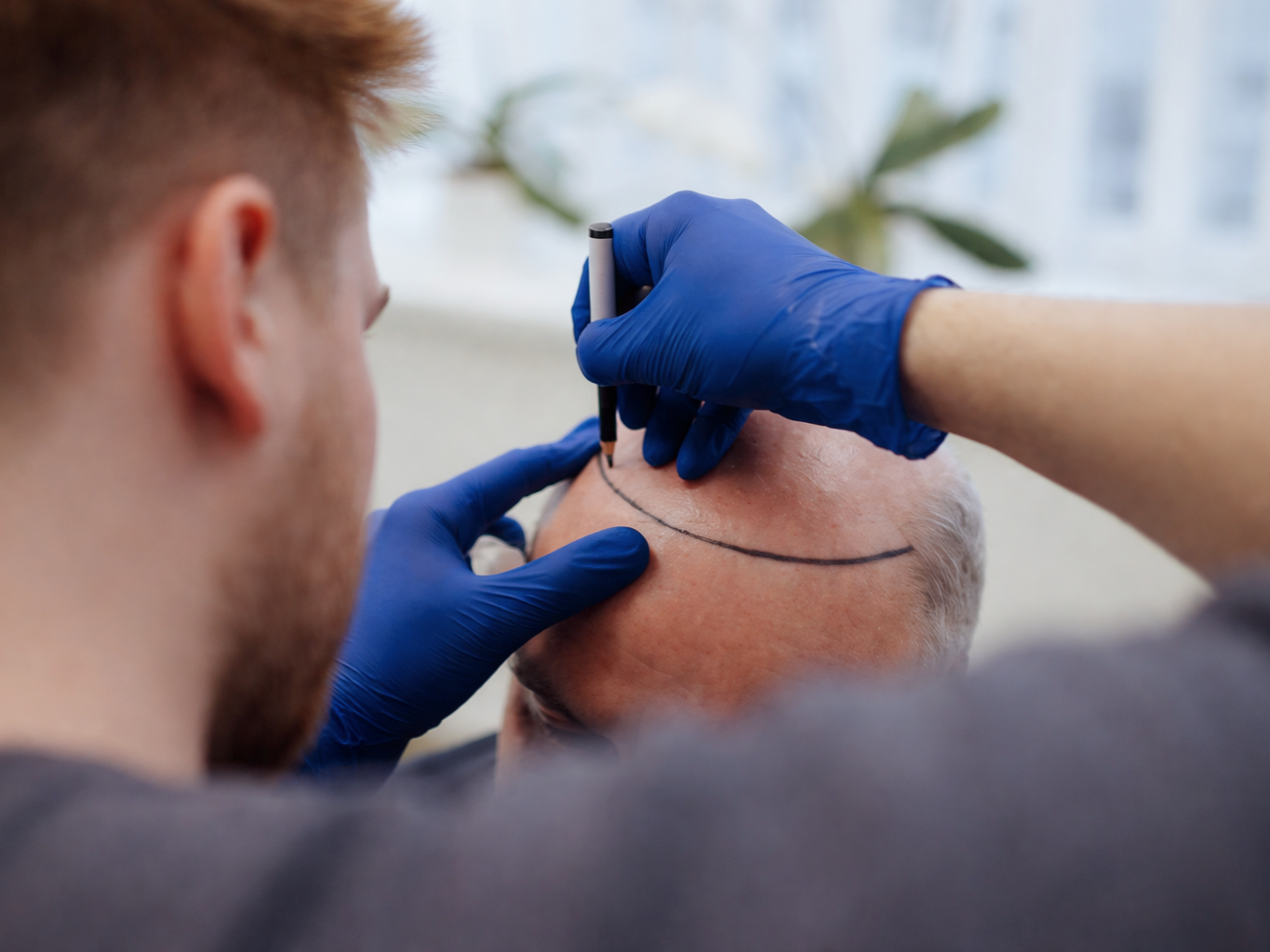 What Defines the Best Hair Transplant Clinic in Ottawa?