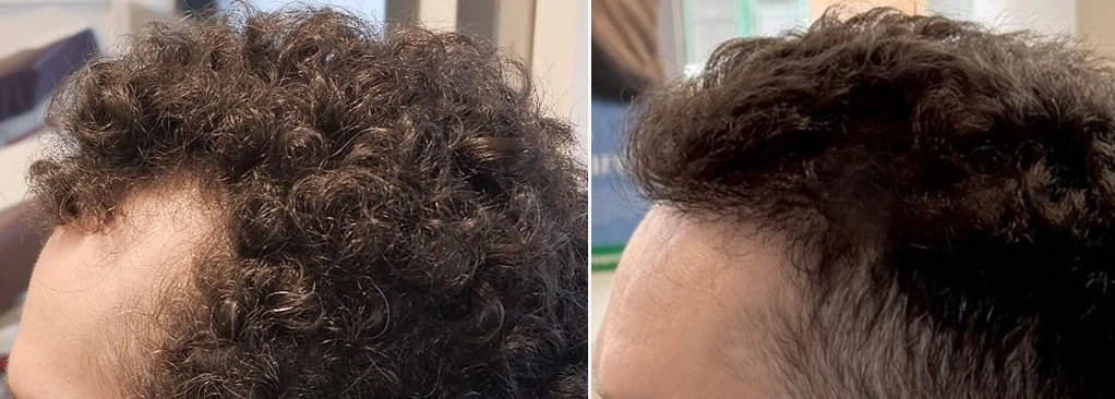 hair_transplant_before_and_after 2 (narrow v2).jpg