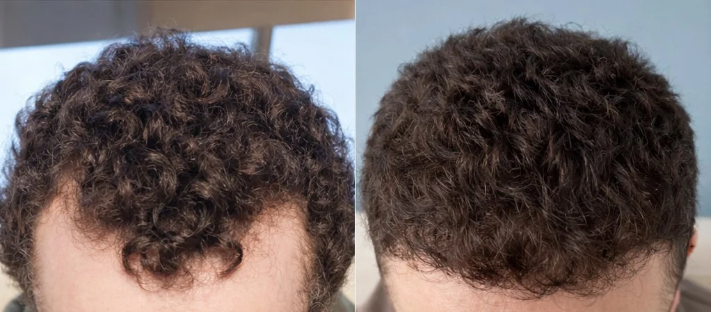  Before and after images of a patient treated with FUE hair transplantation focused on the temporal hairline. Grafts were strategically placed along the side temples to address recession and restore a more even, round and natural hairline contour. 