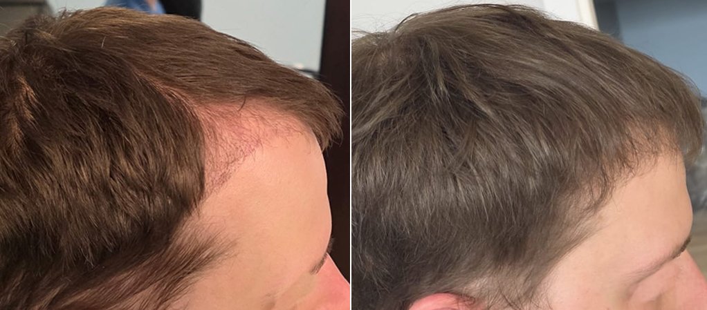 Side-profile before and after photos of the same patient's hairline following FUE hair transplant surgery at Apex Hair Restoration in Ottawa.