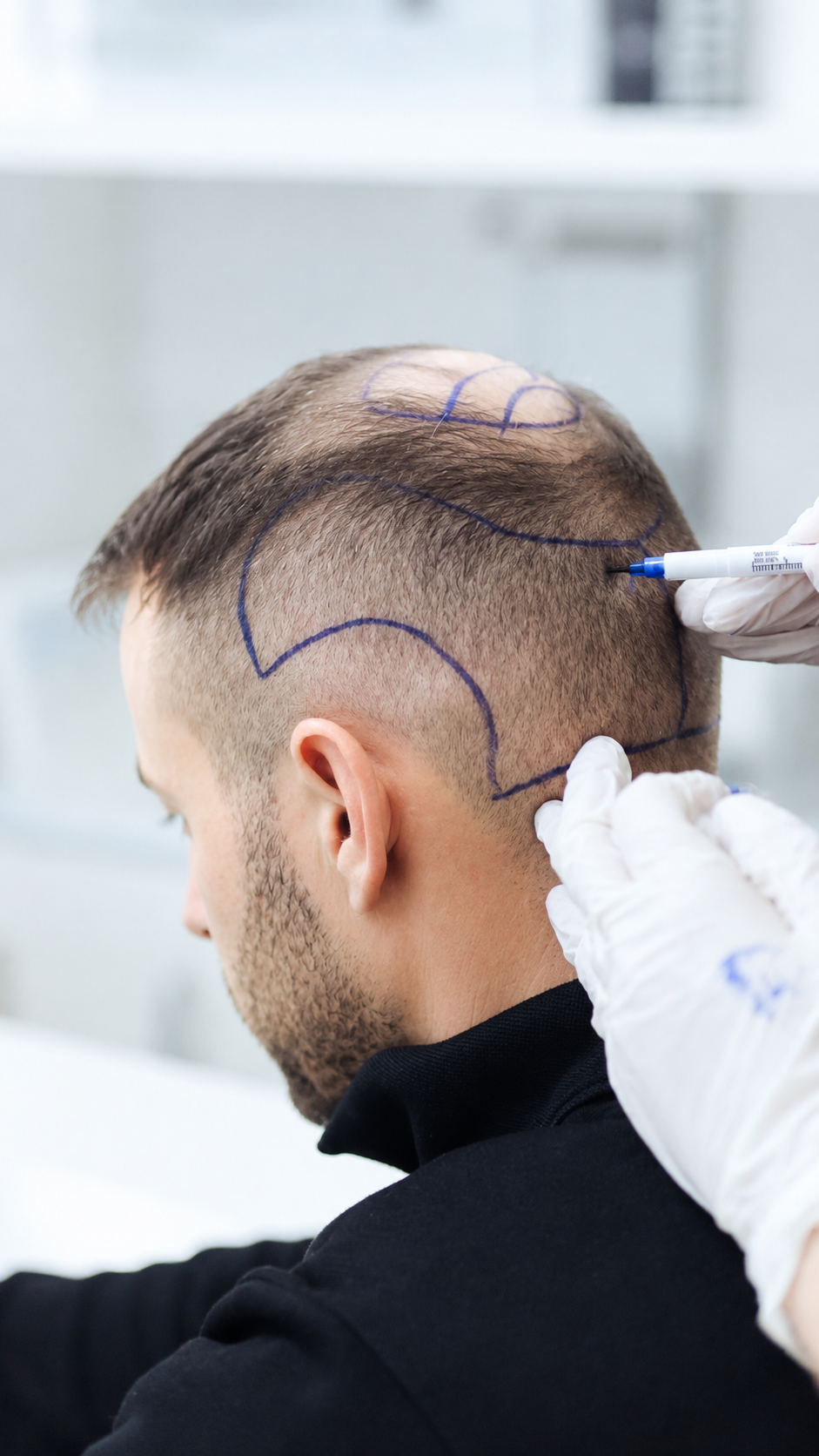 How PRP Improves Graft Survival After a Hair Transplant
