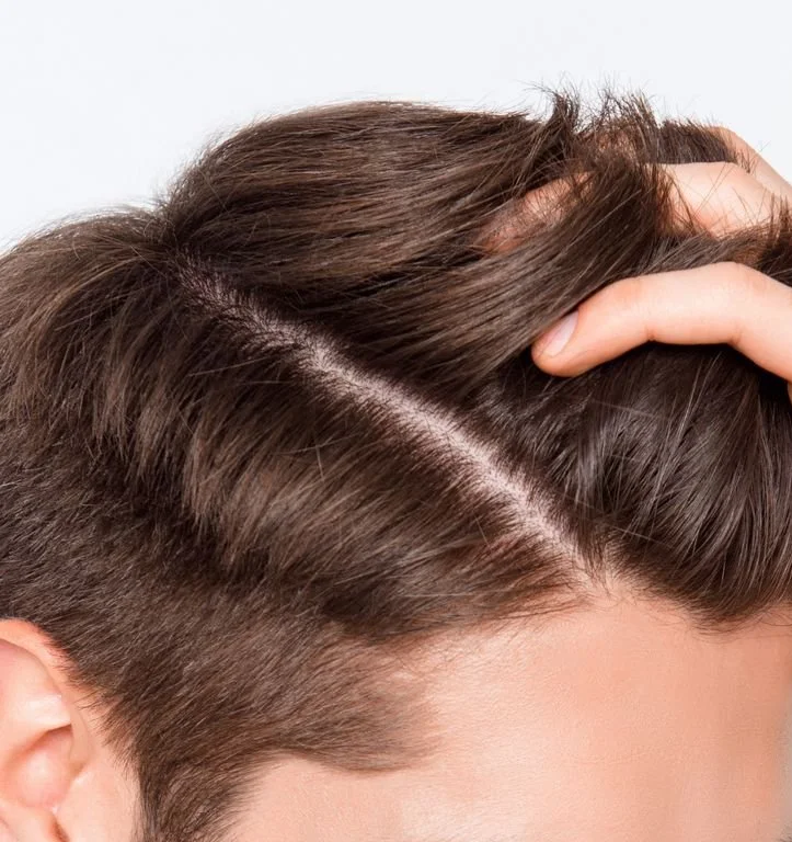 Healthy, full hair representing PRP hair restoration treatment in Ottawa