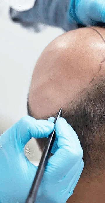 FUE hair transplant procedure being performed at Ottawa hair restoration clinic