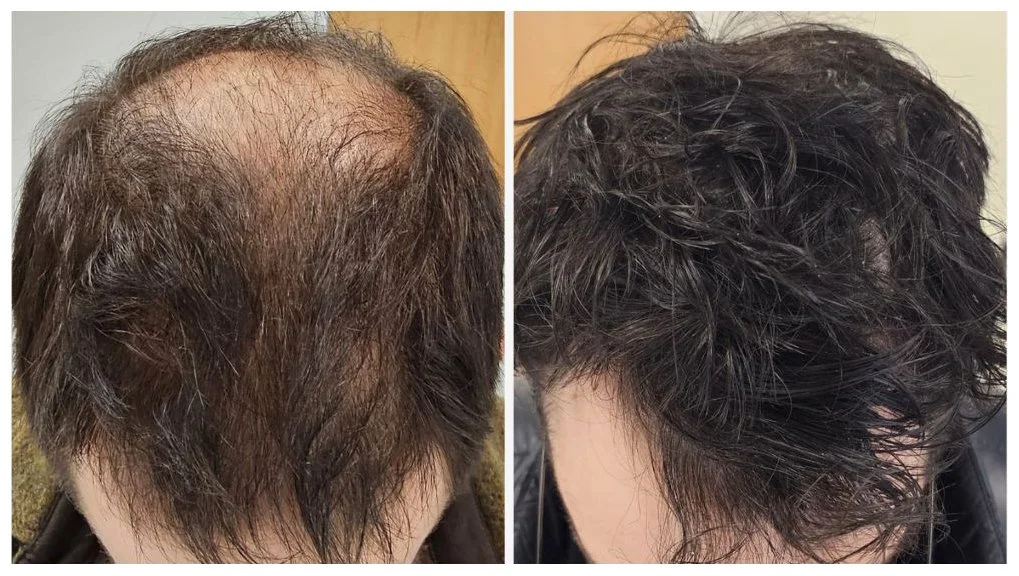 Side-by-side comparison of a man's scalp before and after hair restoration, showing increased hair density and coverage.