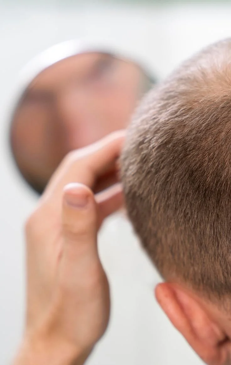 Man examining thinning hair in mirror before FUE hair transplant consultation in Ottawa