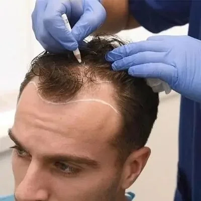 FUE hair transplant procedure being performed on hairline at Ottawa clinic