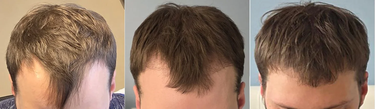 Three-stage front-view progression of a patient's hairline before, during regrowth, and after FUE hair transplant surgery at Apex Hair Restoration in Ottawa.