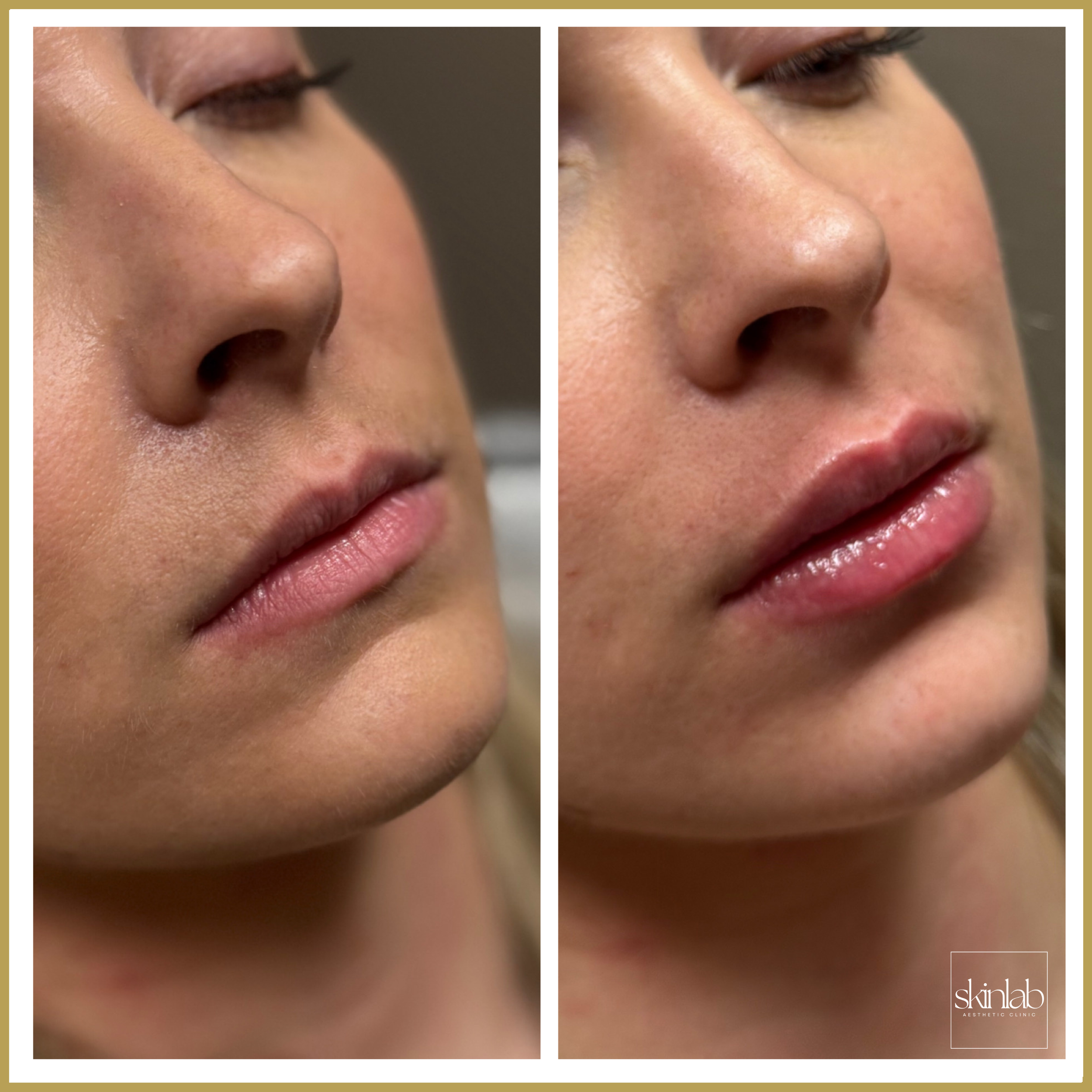 Lip filler before and after results at SkinLab Aesthetic Clinic in Tallahassee, FL.