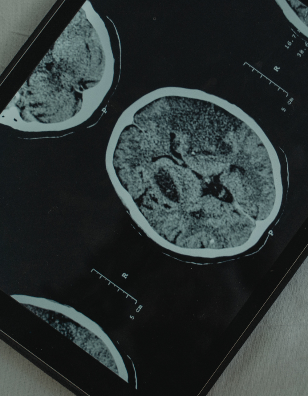 HBOT and Brain Health: How Oxygen Supports Memory, Focus and Mood