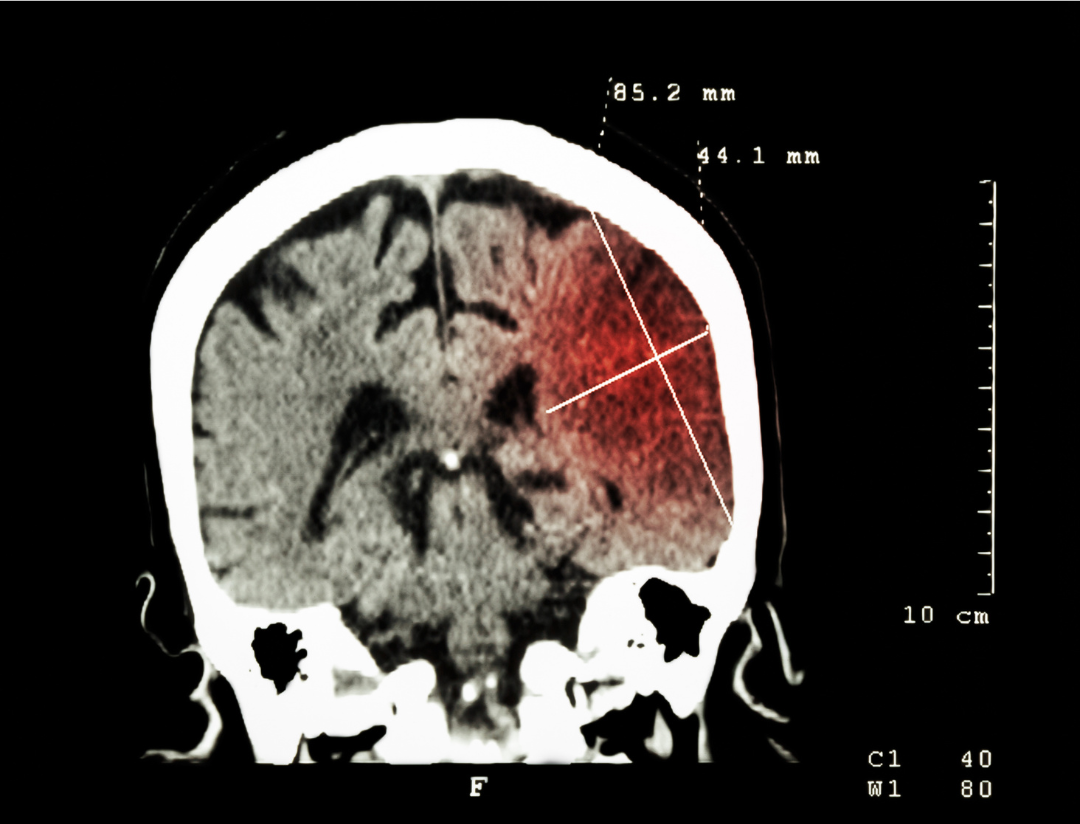 HBOT and Stroke Recovery: Timing, Evidence and What to Expect