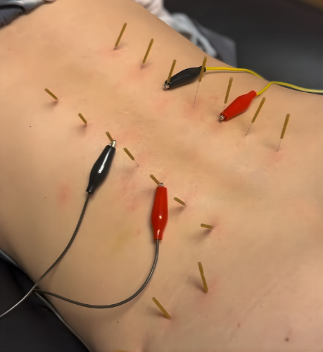 Therapeutic needle-based treatment used to address muscle tension and pain