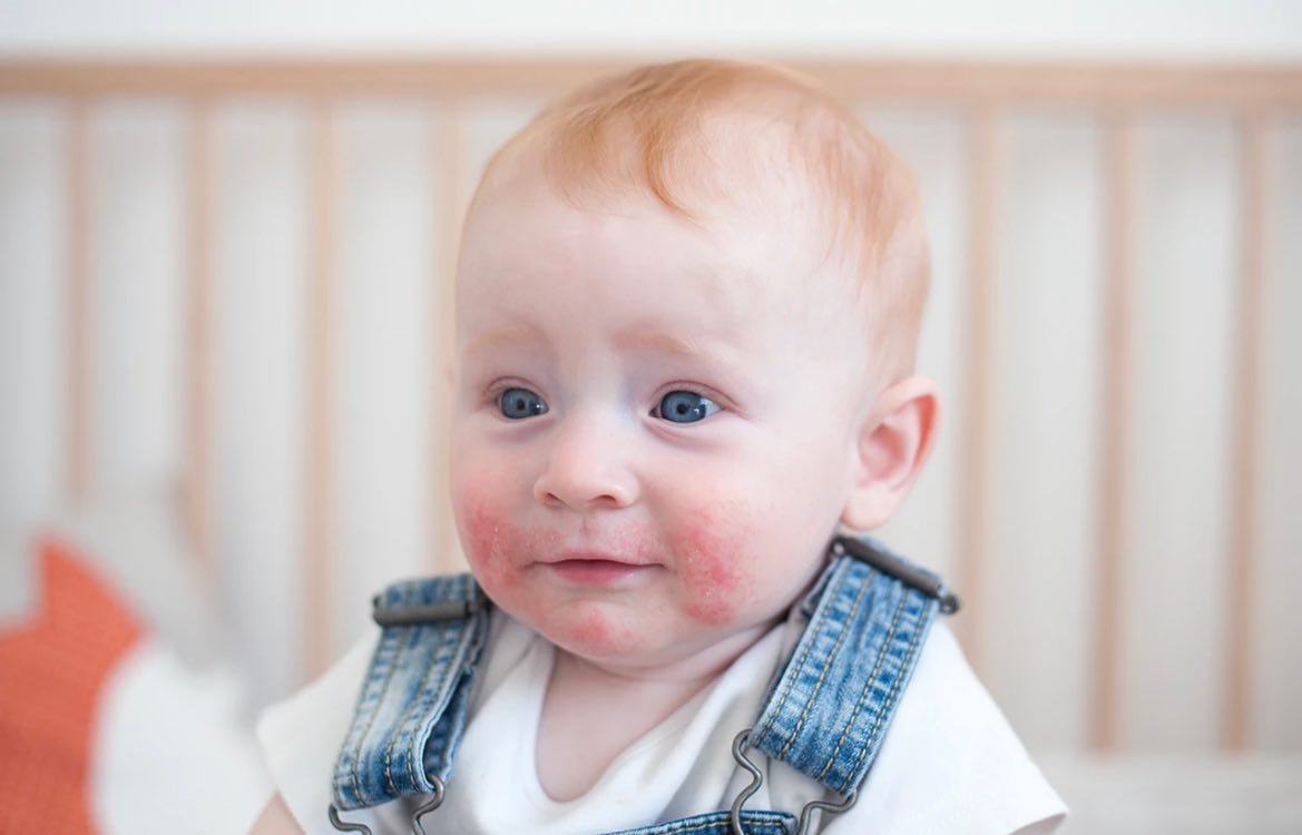 Are you curious about how TCM treat Atopic dermatitis?(Atopy) 
Please check out my blog!

Miraan.au

https://www.thewell.tv/post/atopic-dermatitis-and-environmental-factors

#atopicdermatitis #atopicskin #acupuncuture #naturaltherapyforallergies #all