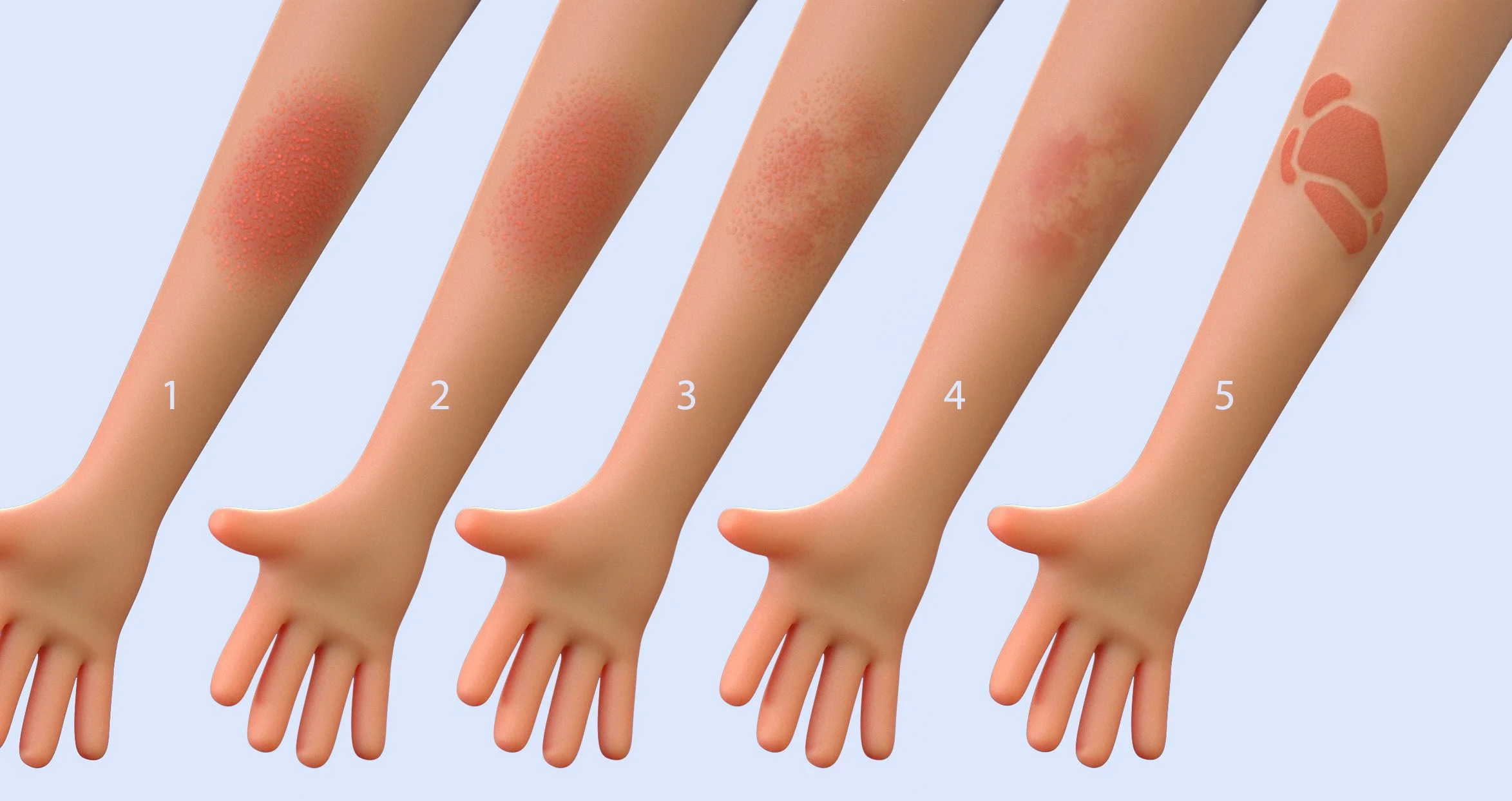 LeighPearce-Arm-eczema-tests.jpg