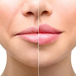 Close-up of a woman's face showing a before and after comparison of skin or lip treatment, with the left side showing less smooth skin and the right side showing smoother, clearer skin and lips.