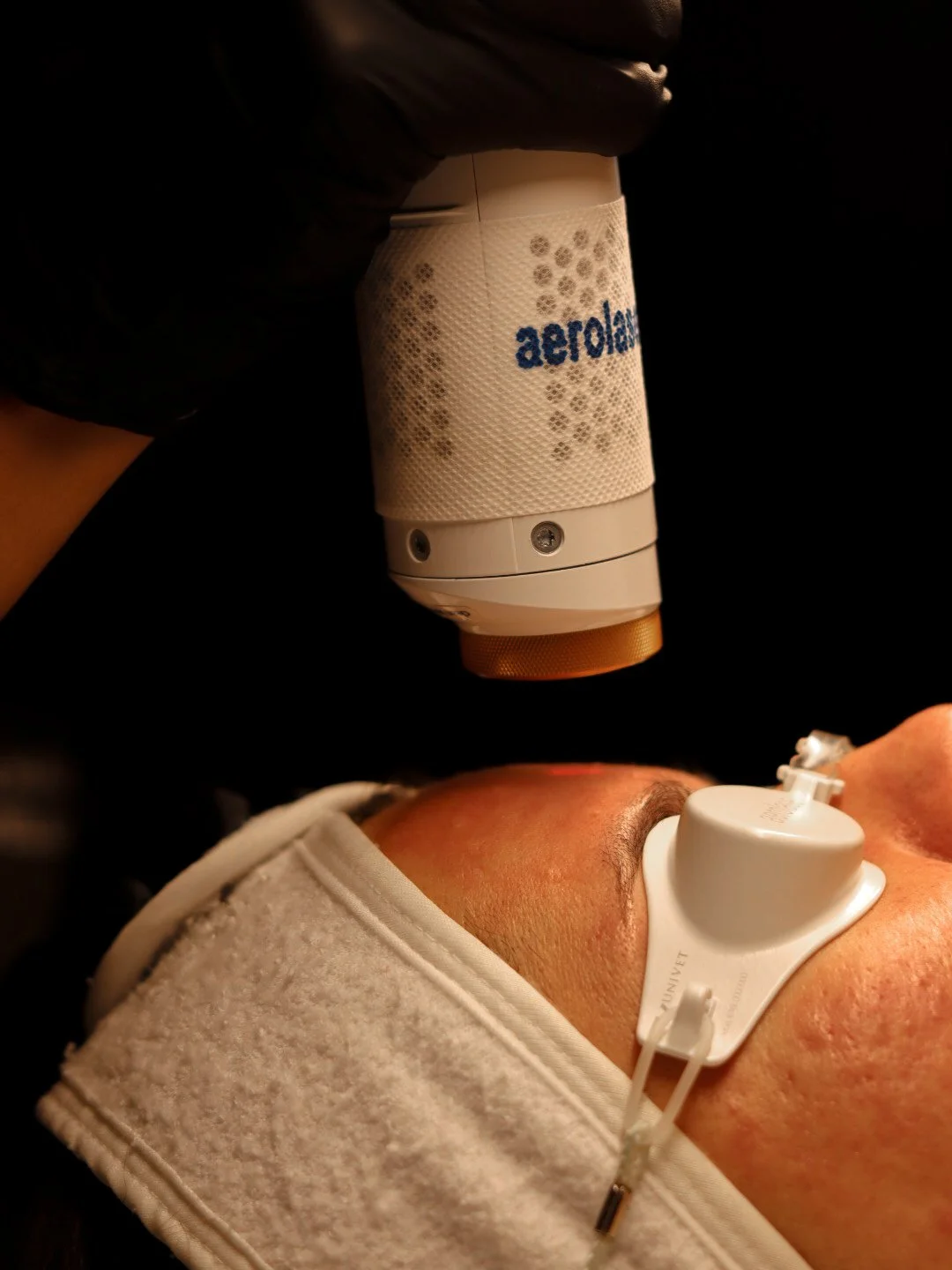 Men’s Aerolase (half face) Skin Rejuvenation series of 4